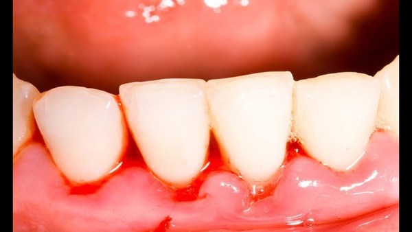 Sonhar com dente sangrando